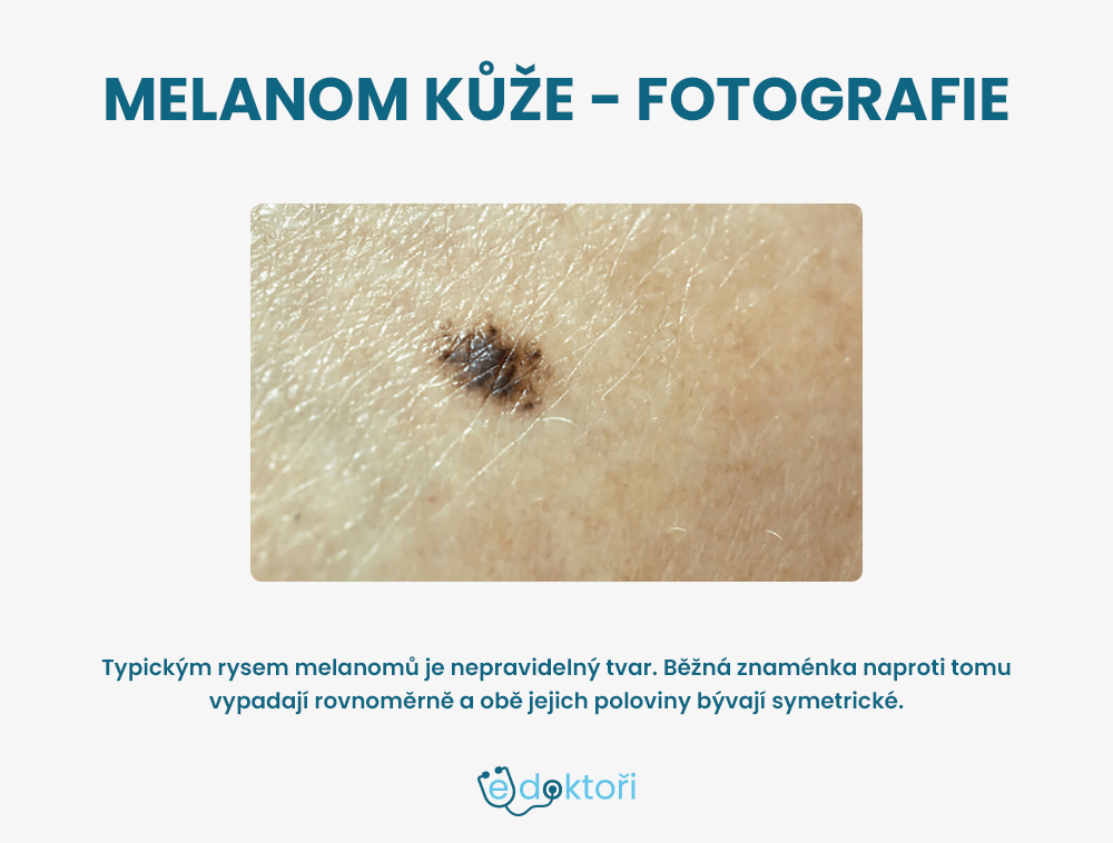 melanom kůže foto