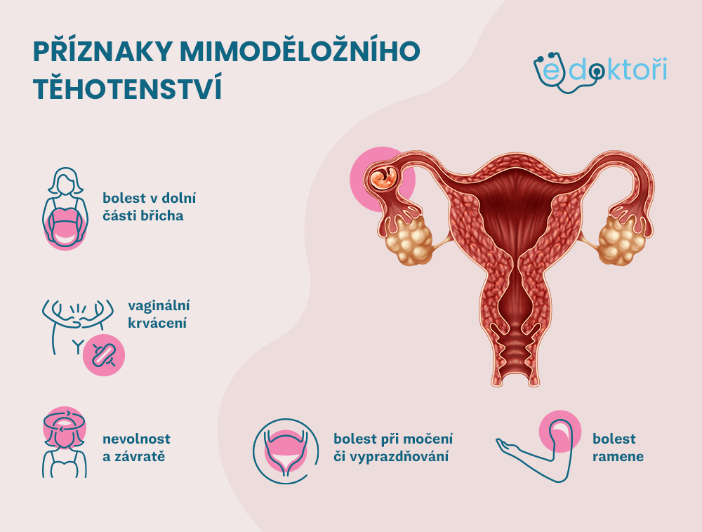 mimoděložní těhotenství příznaky