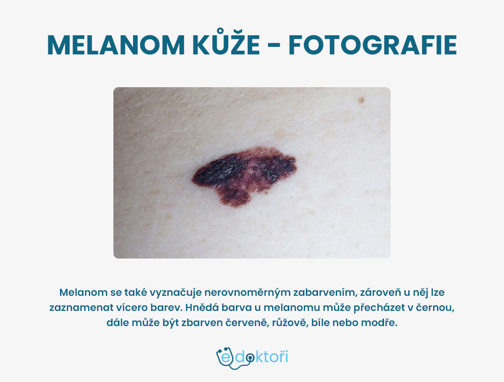 melanom kůže obrázky