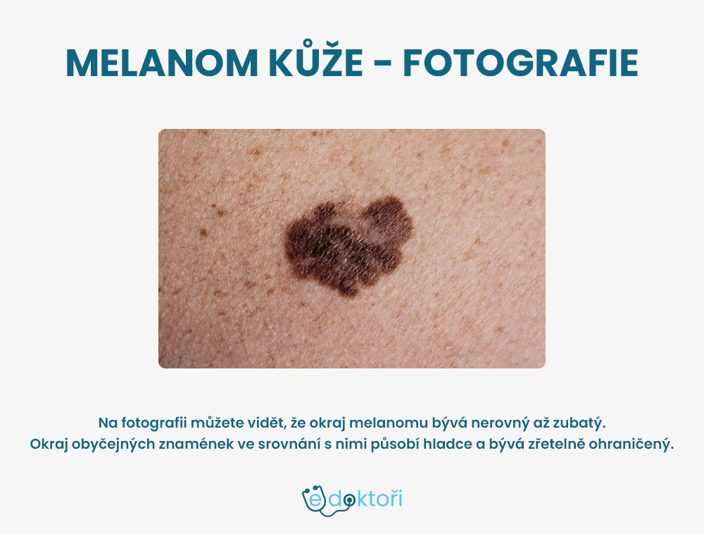 melanom kůže foto