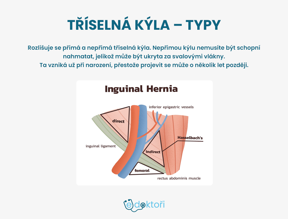 tříselná kýla obrázek
