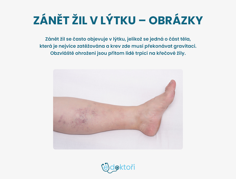 Autor: Redakce edoktori.cz Zánět žil v lýtku