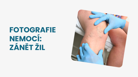 Zánět žil obrázky