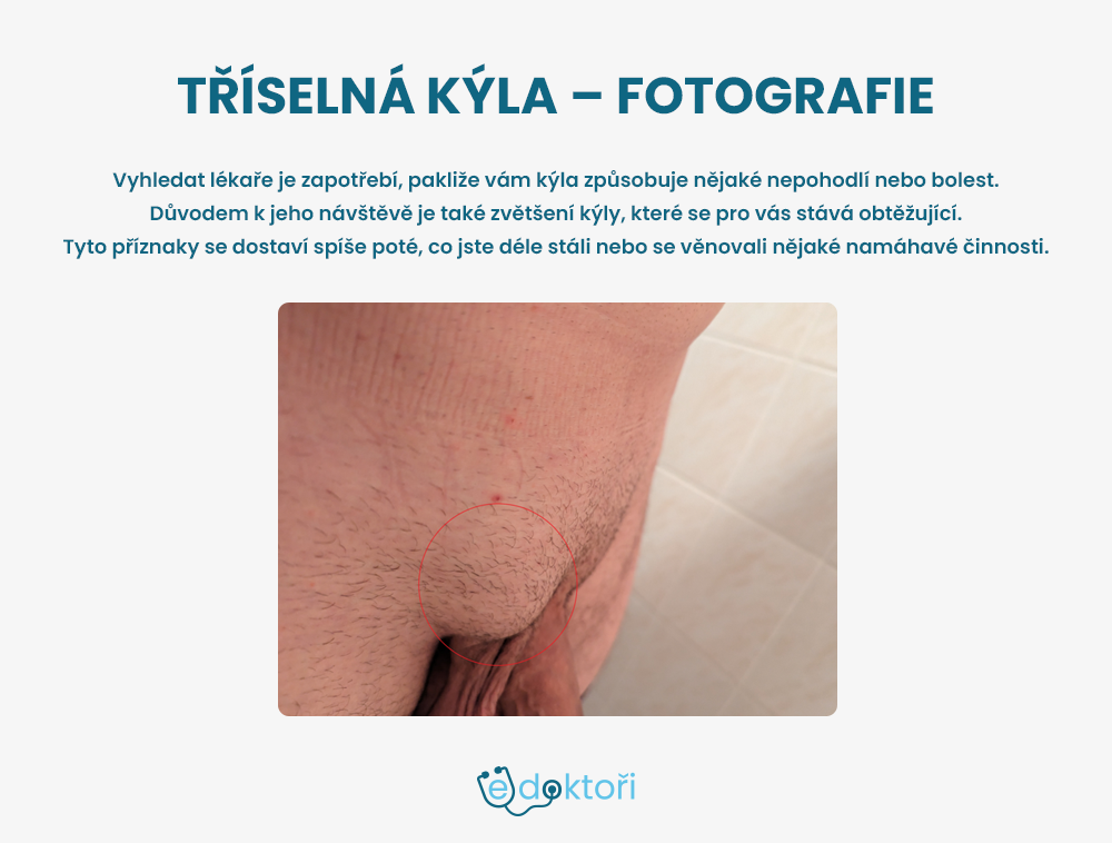 tříselná kýla foto