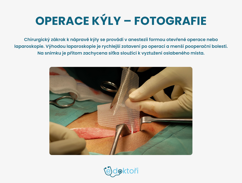 Břišní kýla operace - fotografie