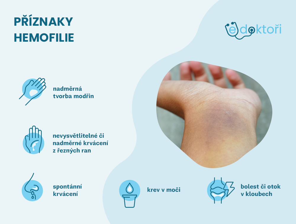 Autor: Redakce edoktori.cz příznaky hemofilie