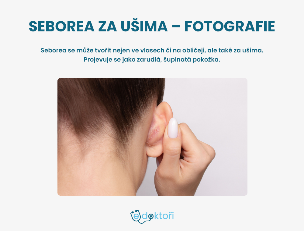 Seborea za ušima obrázky
