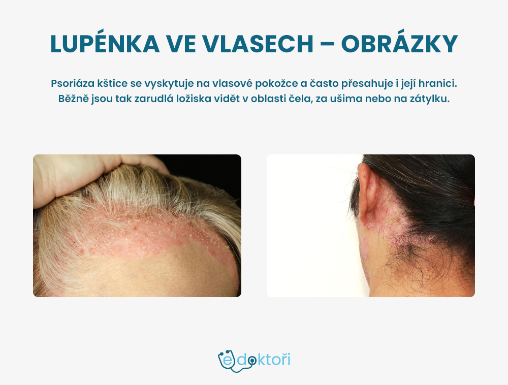 Lupénka ve vlasech