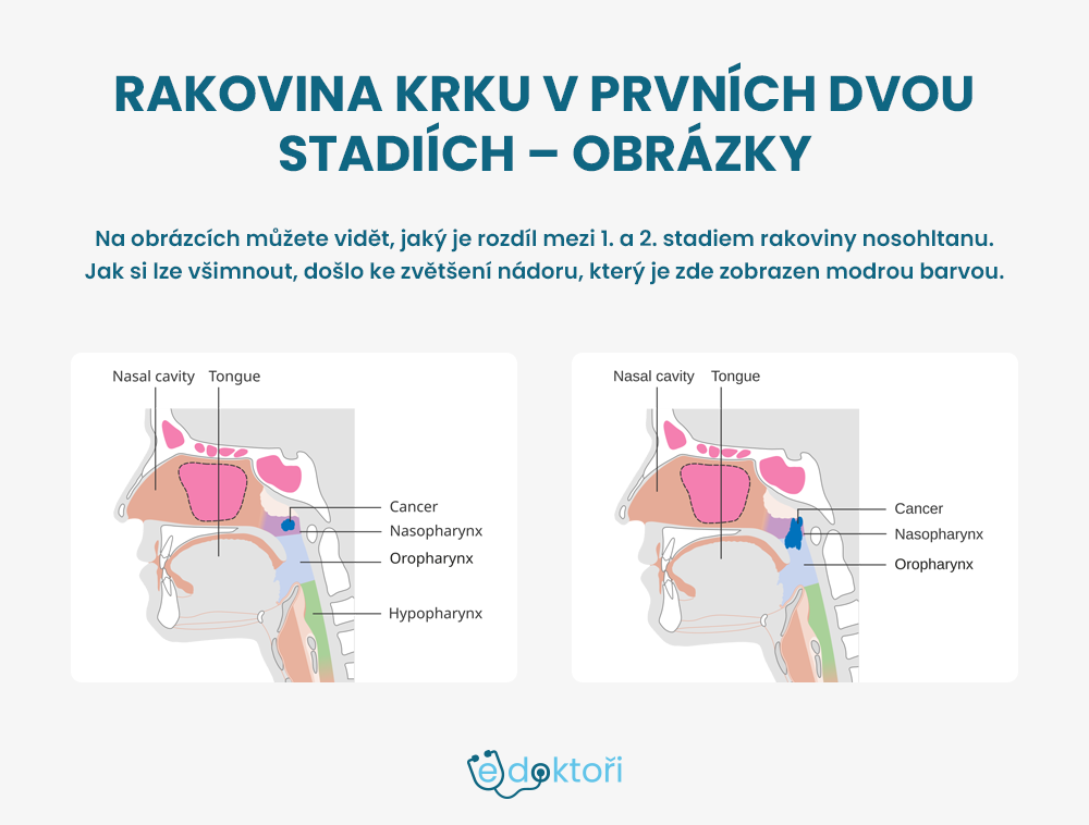 Rakovina krku - fotografie stadií