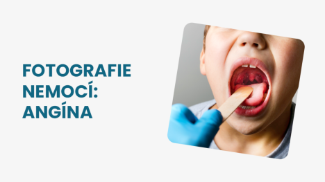 Angína foto krku