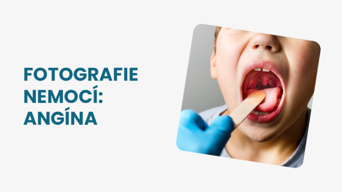 Angína foto krku