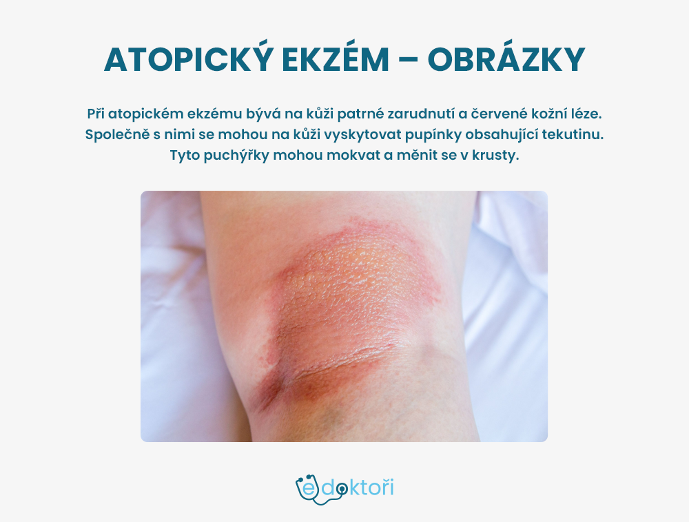 Atopický ekzém - obrázky