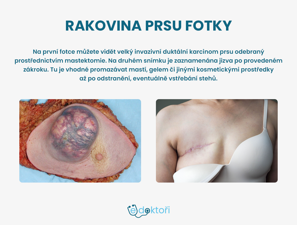 Autor: Redakce edoktori.cz rakovina prsu fotky