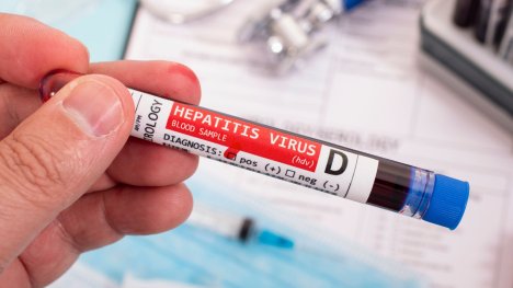 Hepatitida D
