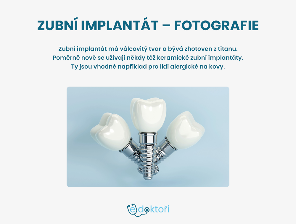 Zubní implantát fotografie