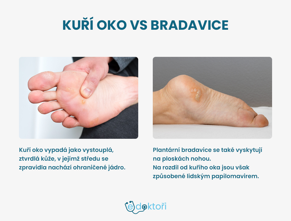 Kuří oko vs bradavice