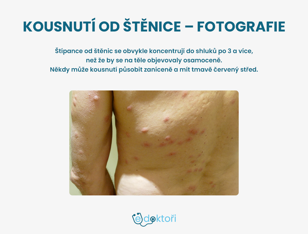 Kousnutí od štěnice