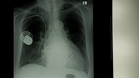 Kardiostimulátor diskuze