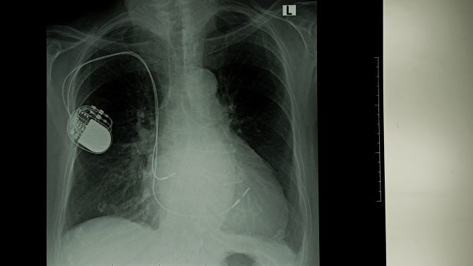Kardiostimulátor diskuze