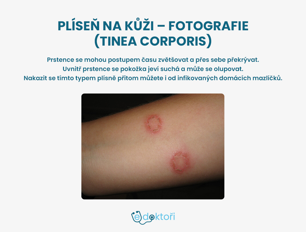 plíseň kůže - tinea corporis foto