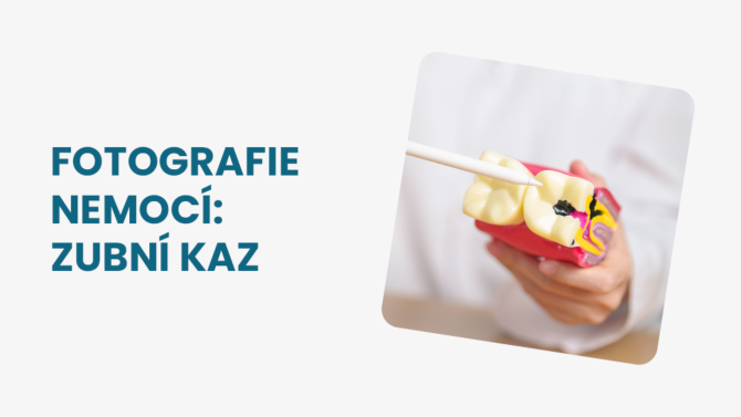 Jak vypadá kaz na zubu