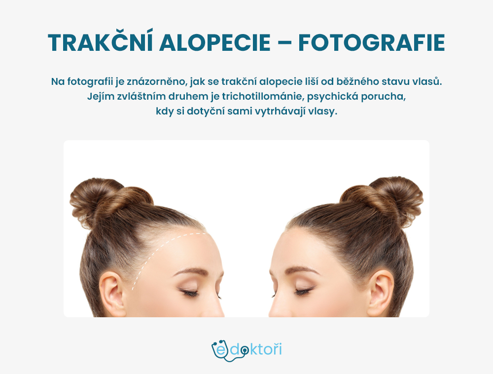 Trakční alopecie