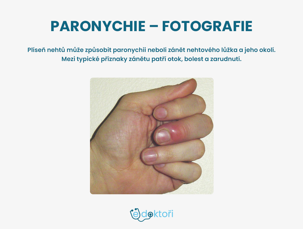 Paronychie