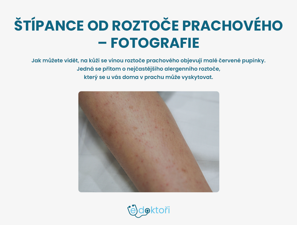 štípance od roztoče prachového foto