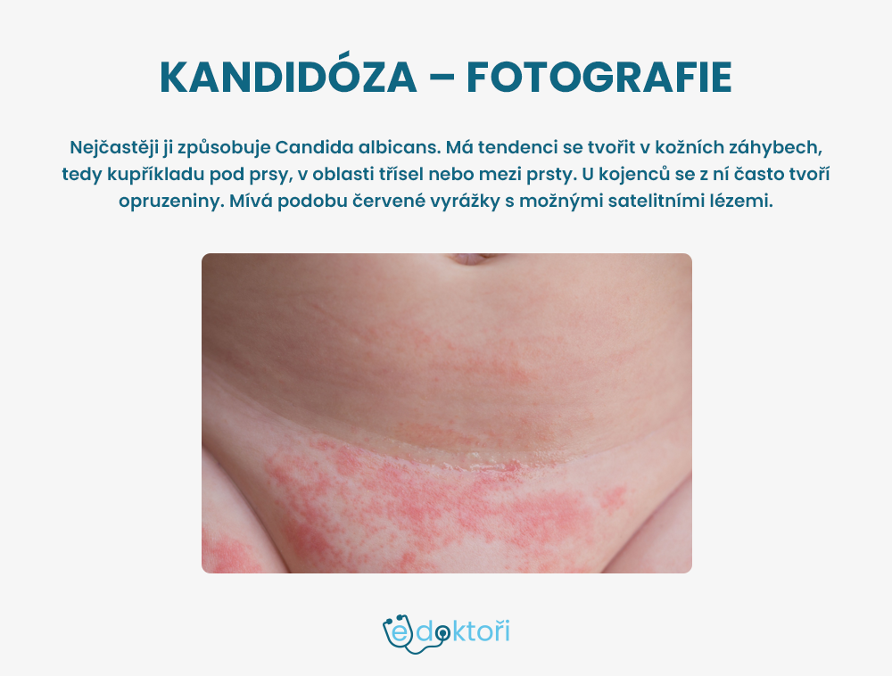 kandidóza foto