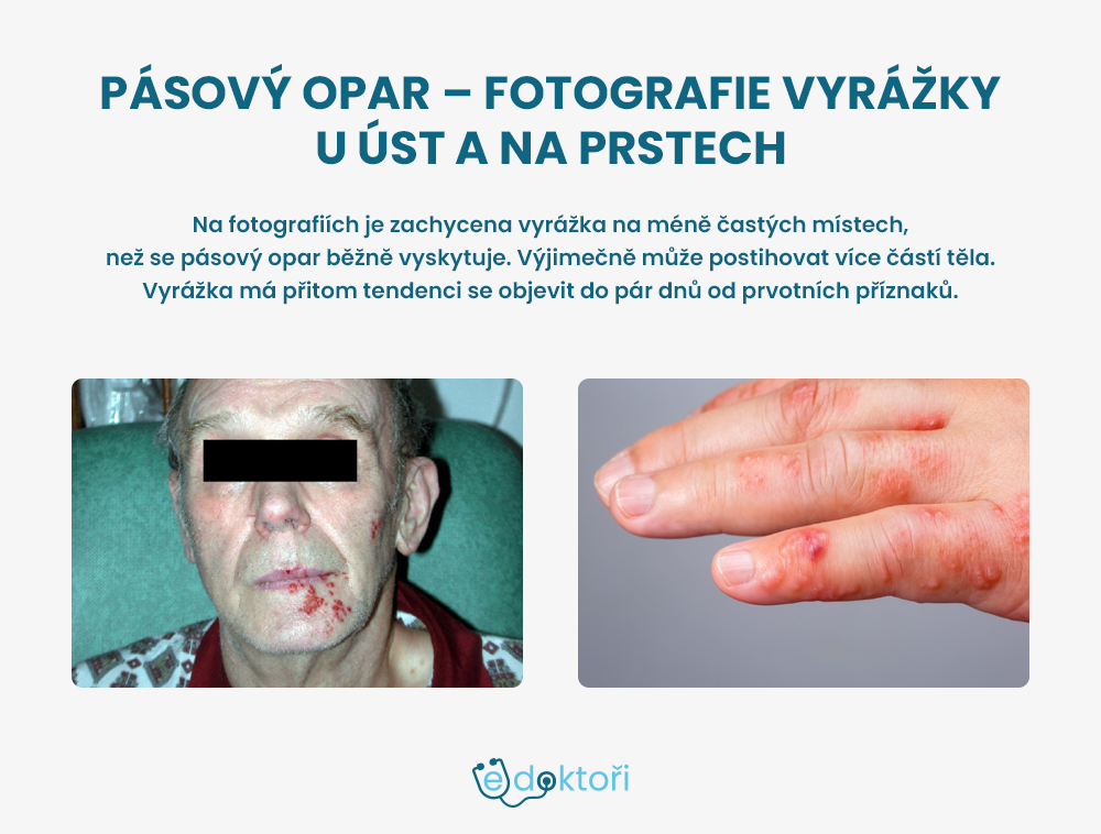 Pásový opar u rtu a na prstech - fotografie