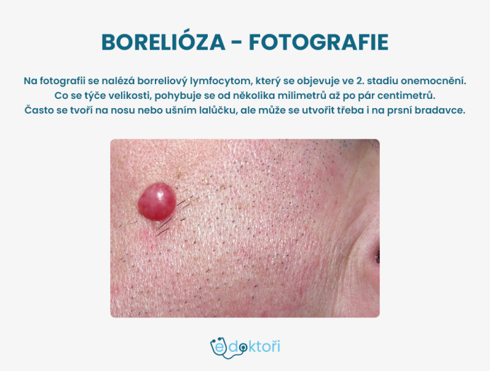 Borreliový lymfocytom