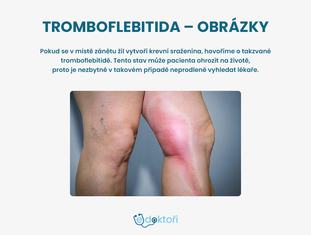 Autor: Redakce edoktori.cz Tromboflebitida