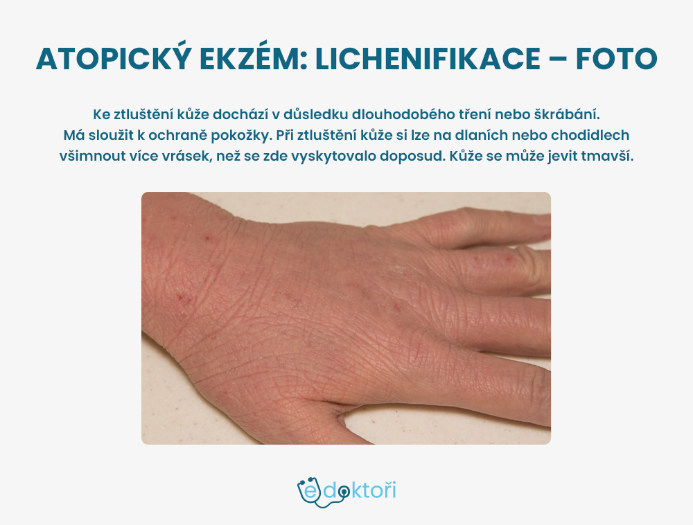 Atopický ekzém foto