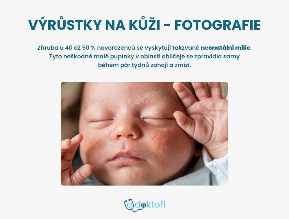 neonatální milie