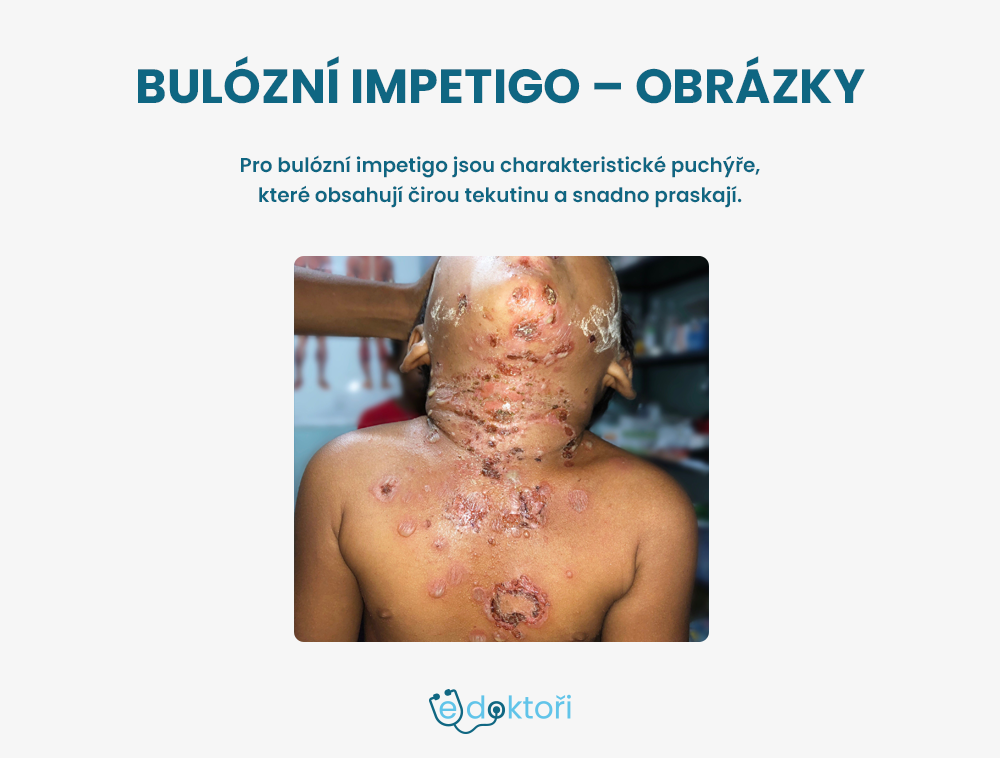 Bulózní impetigo