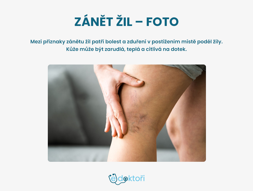 Autor: Redakce edoktori.cz Jak vypadá zánět žil