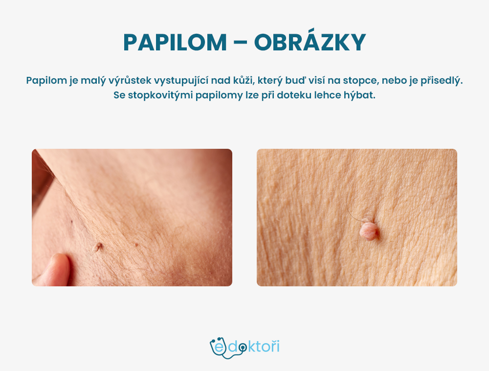 papilom obrázky