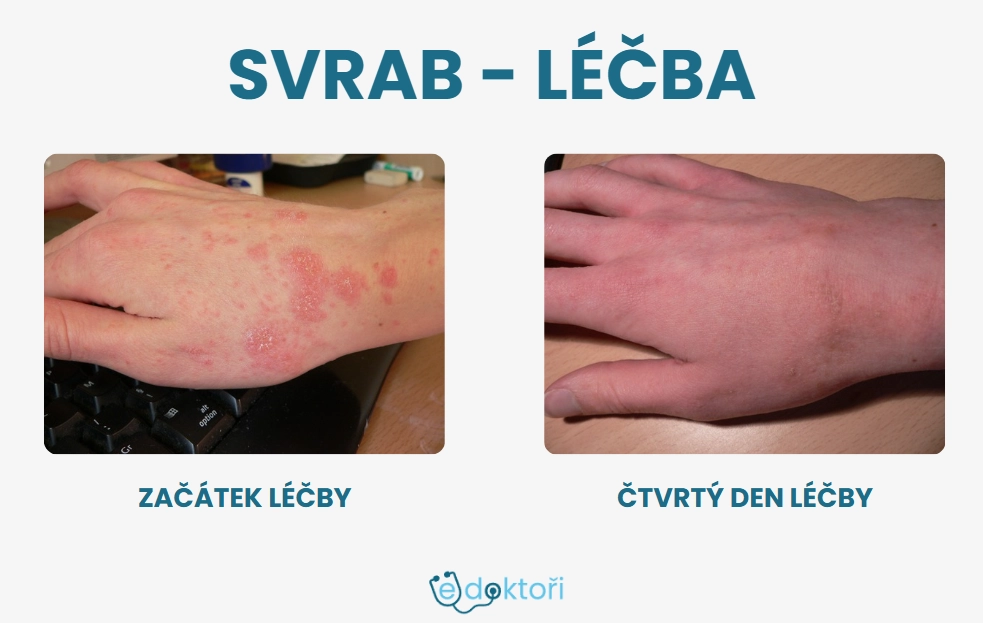 svrab fotografie - léčba
