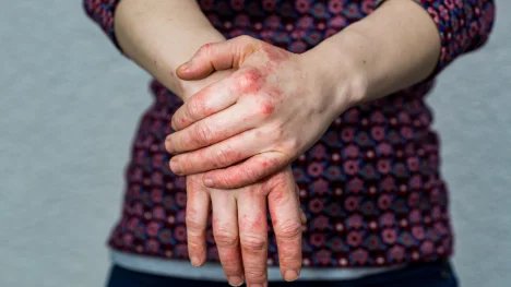 Dyshidrotický ekzém postihuje nejčastěji ruce a chodidla. Hlavními spouštěči jsou stres a alergeny
