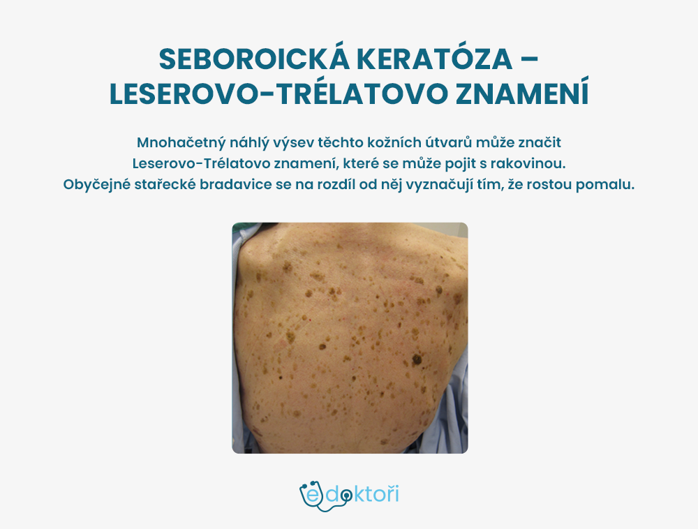 Leserovo-Trélatovo znamení foto
