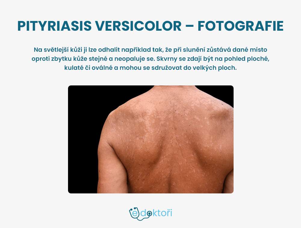 Pityriasis versicolor  foto