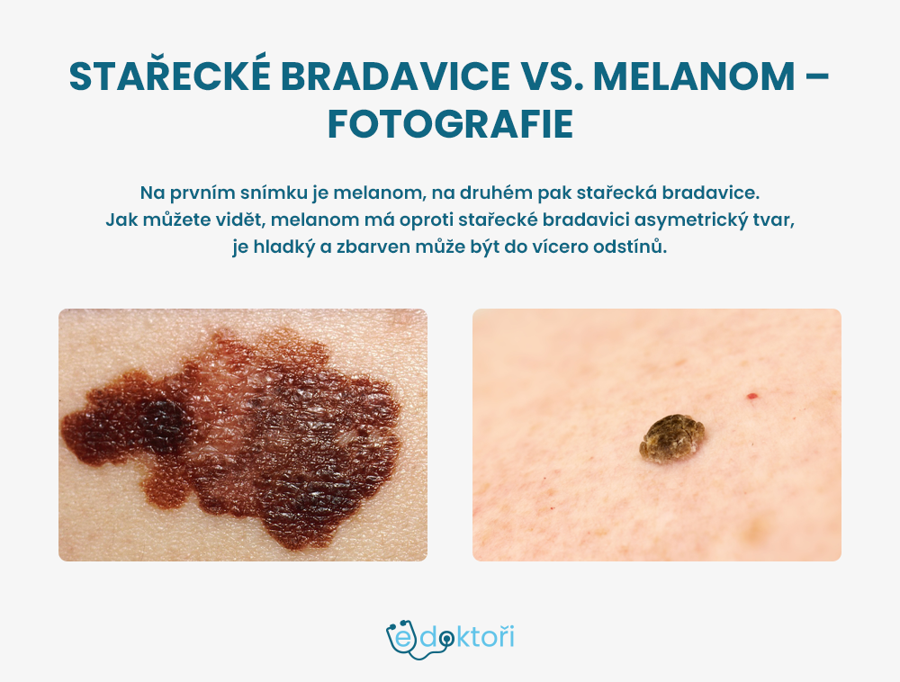 Stařecké bradavice a melanom fotografie