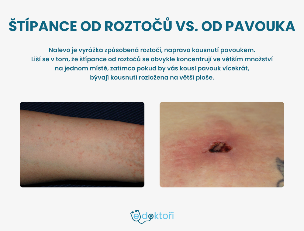 štípance od roztočů vs. od pavouka