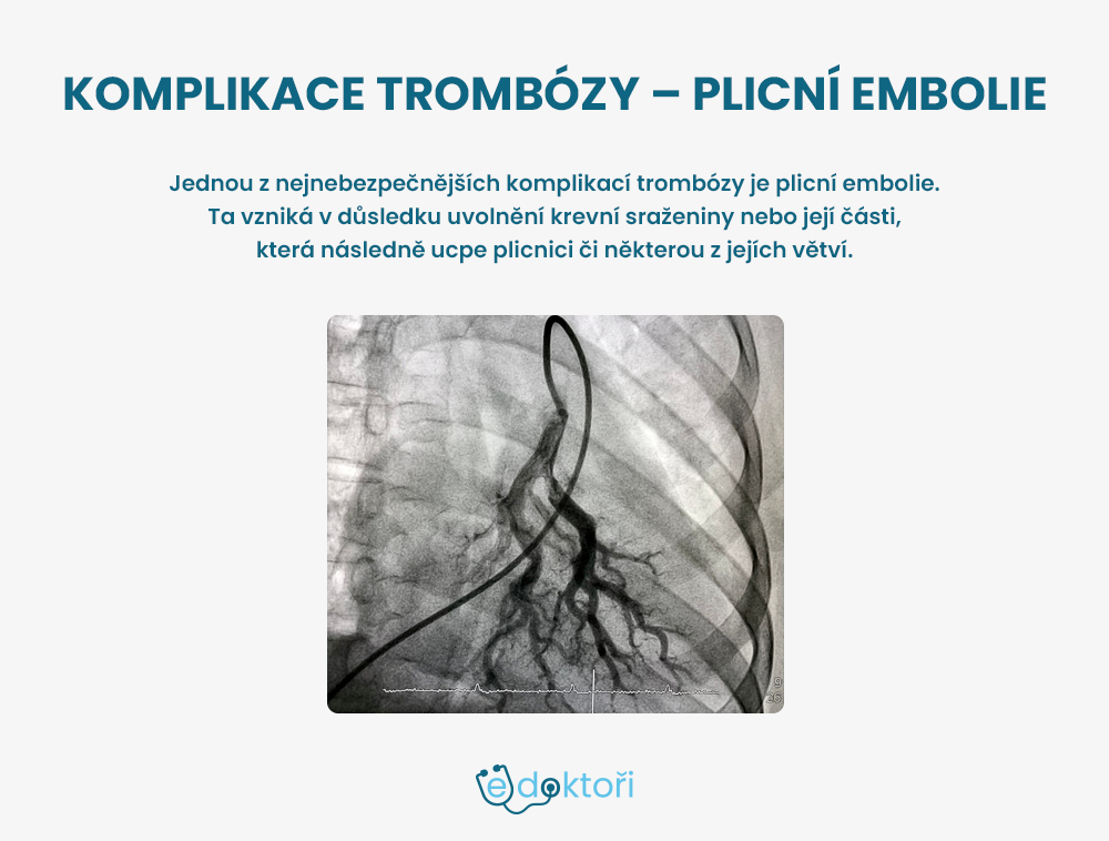 Komplikace trombózy – plicní embolie