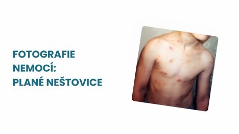 plané neštovice foto