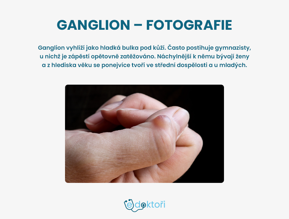 Ganglion na prstu fotografie