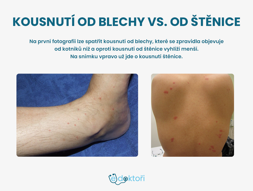 Kousnutí od štěnice a blechy