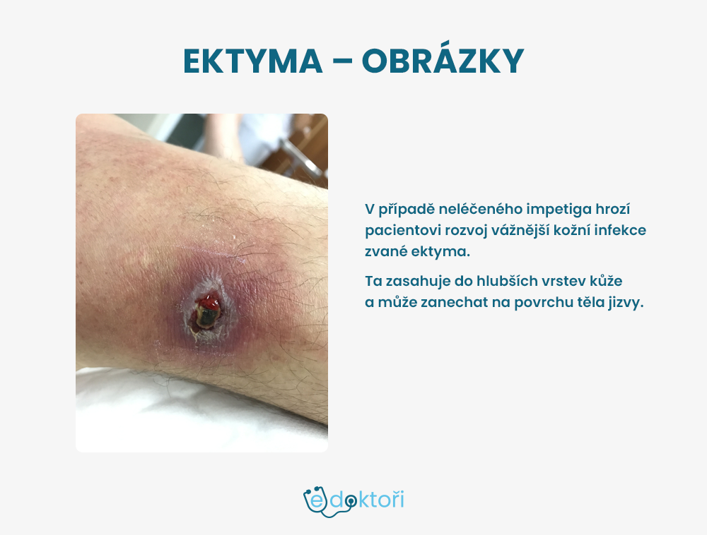 Ektyma
