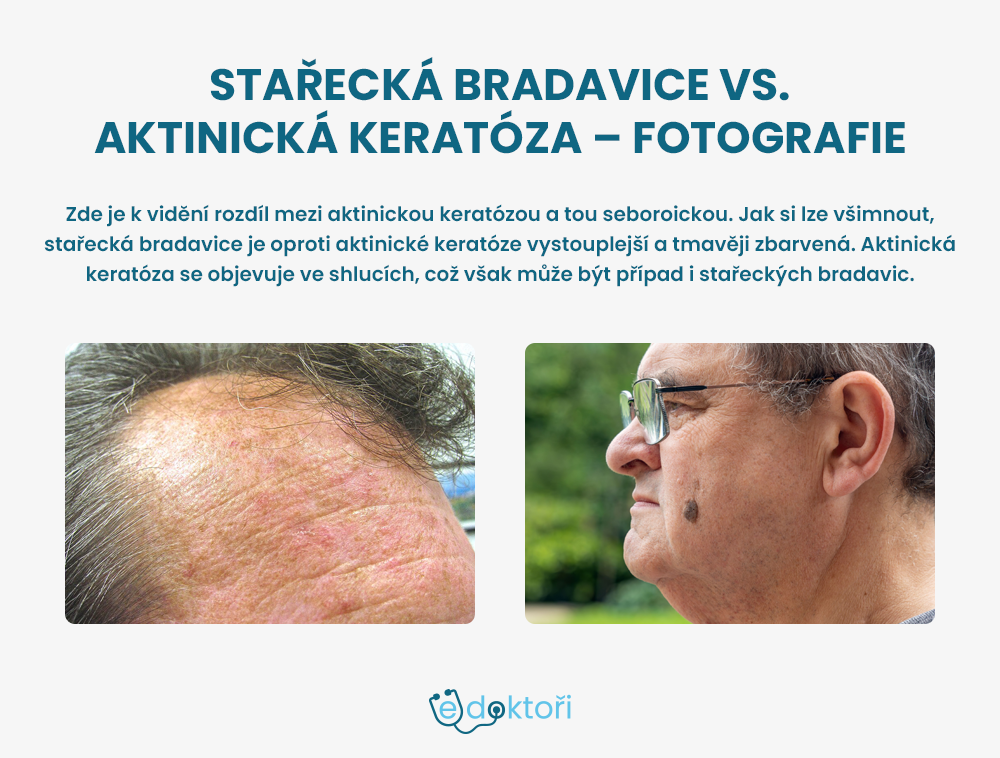 stařecké bradavice a aktinická keratóza fotografie