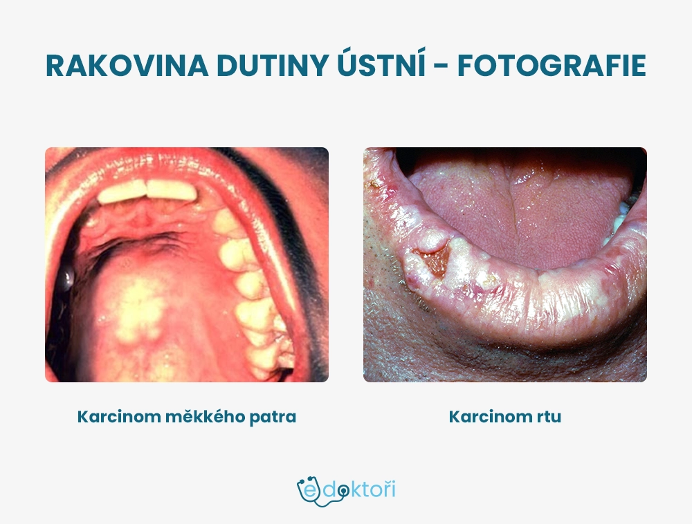 Rakovina dutiny ústní fotografie